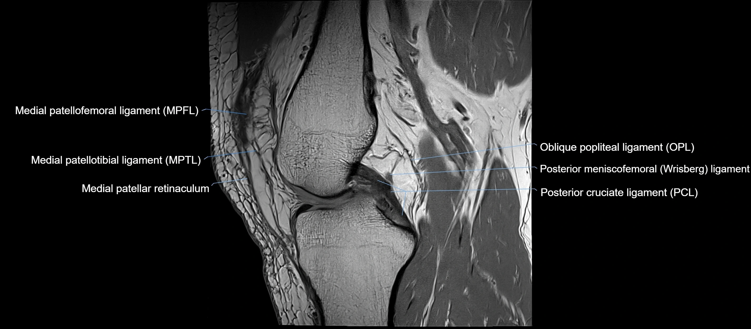 MRI sagittal  ligaments cross sectional anatomy 3T  radiology  image-img-00001-00022.webp